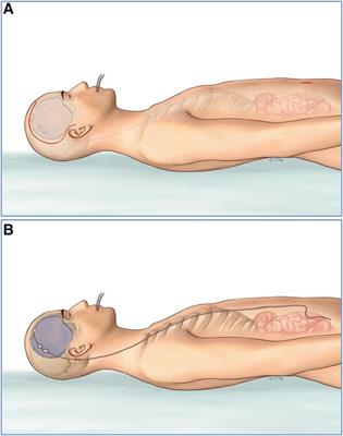 Improved strategy for post-traumatic hydrocephalus following decompressive craniectomy: Experience of a single center